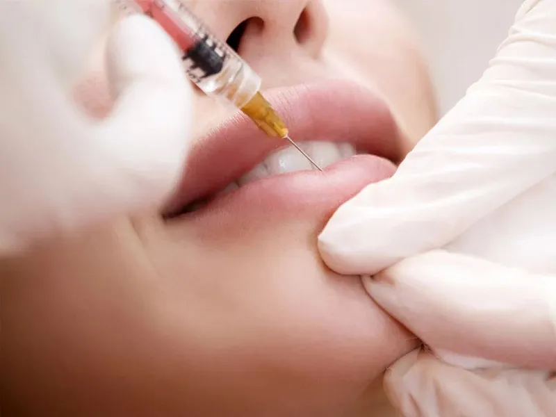 CE Certified Dermal Fillers for Fine Lines Cases